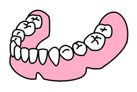総義歯　下　その１.png